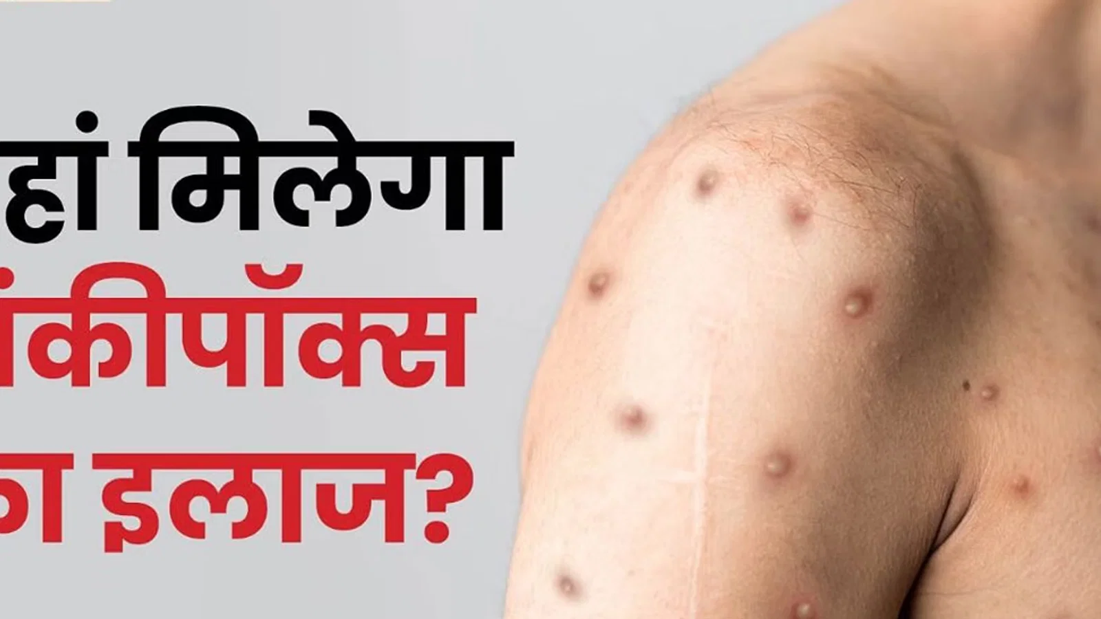 आईसीएमआर अध्ययन: मंकीपॉक्स के दो रूप, असर बराबर त्वचा और अंगों तक वायरस पहुंचने के संकेत; कितना खतरनाक?